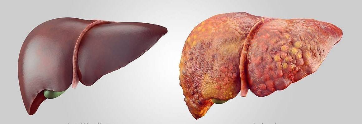 تظهر الصورة وجود مرض الكبد من خلال عرض لكبدين الأولى سليمة والثانية متندبة