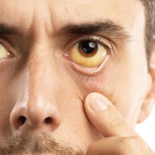 من الأعراض الرئيسية لمرض الكبد وجود اصفرار في العينين
